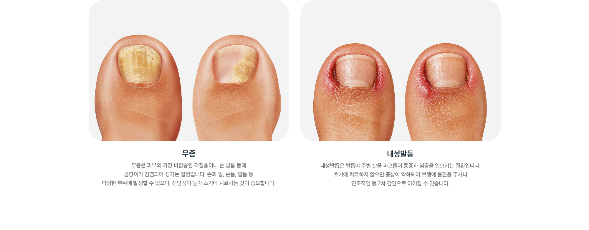문제성 발톱 종류 - 곰팡이 감염으로 생기는 무좀과 발톱이 살을 파고드는 내성발톱 비교