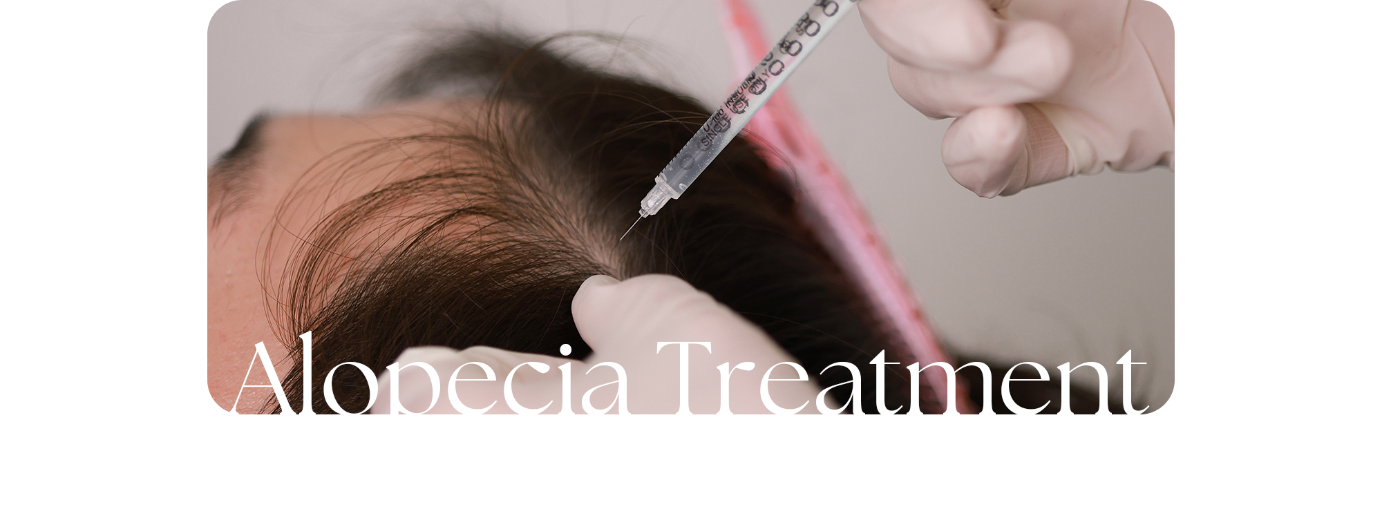 두피·모낭 상태에 맞춰 진행하는 퍼펙트 탈모 치료 Alopecia Treatment