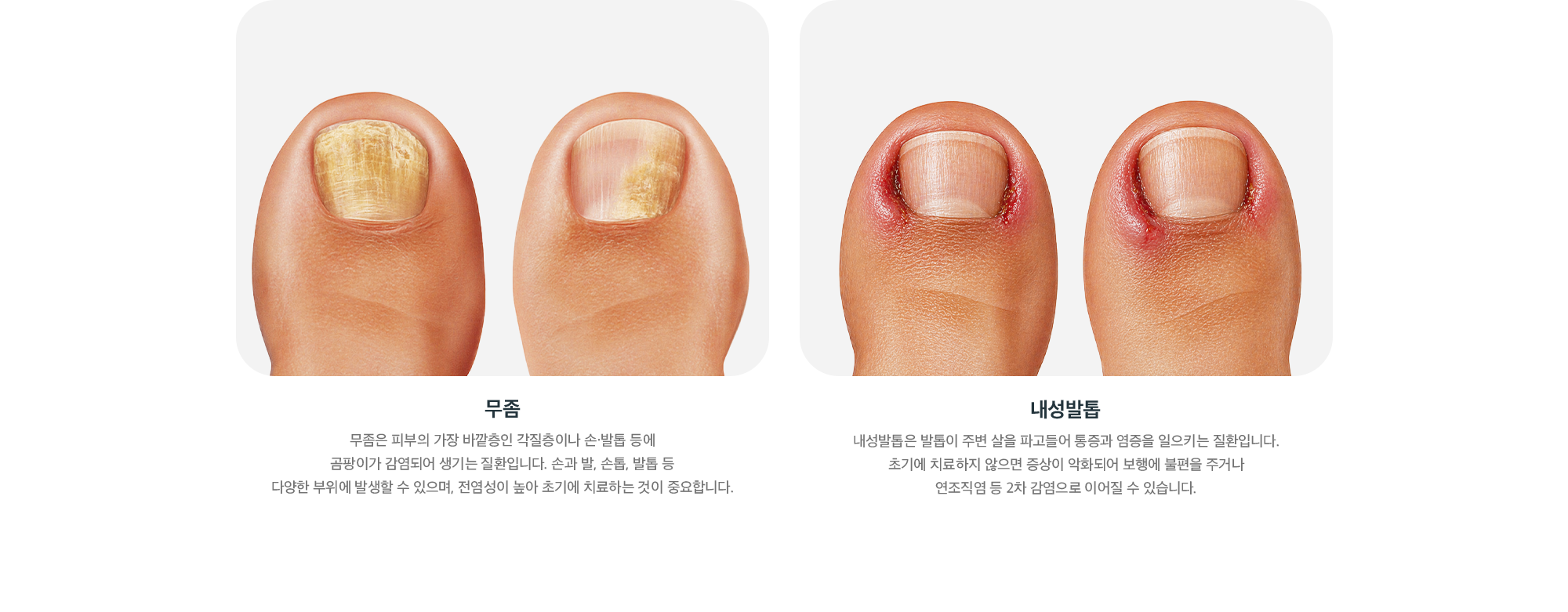 문제성 발톱의 종류 - 무좀과 내성발톱 증상 비교